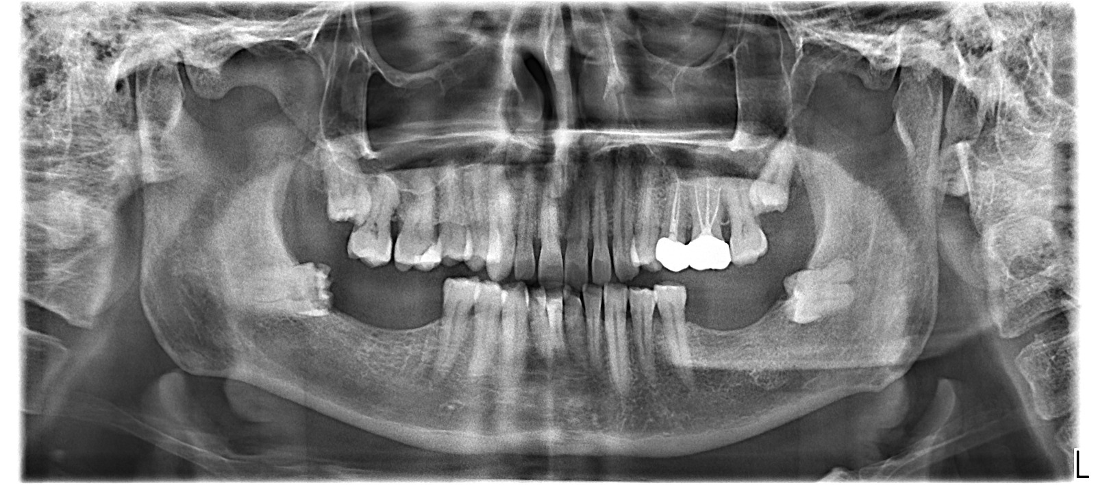Professional wisdom tooth removal procedure